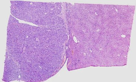 Liver cancer-45
